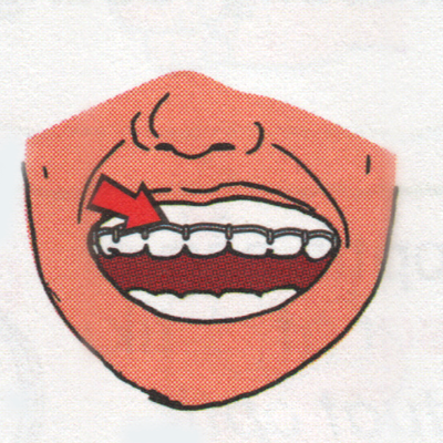 Surapit nipon / Braces / Pengikat gigi